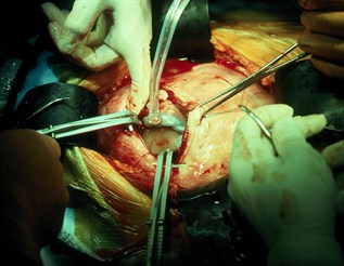 Open Fetal Surgery