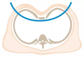 Nuss Procedure Bar Placement