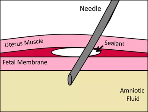 Amnioseal diagram